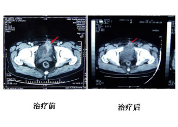 膀胱癌常识