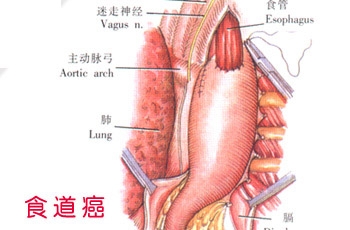 食道癌治疗