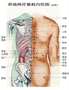 蜂产品抗癌的机理 蜂疗是怎么抗癌的?