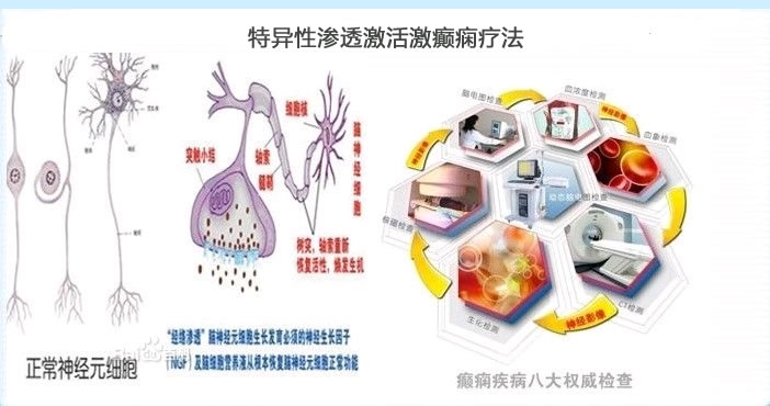 特异性渗透激活激癫痫疗法