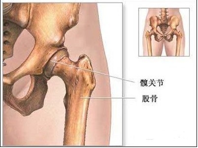 股骨头坏死能治好吗