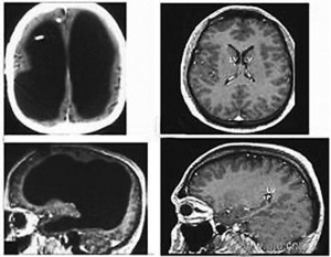 脑瘤积水如何治疗?