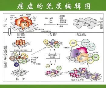 膀胱癌典型病例 膀胱癌患者的康复不再是奢望