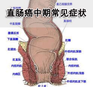 直肠癌的症状有哪些