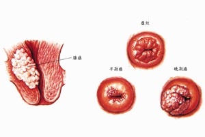 宫颈癌的症状有哪些