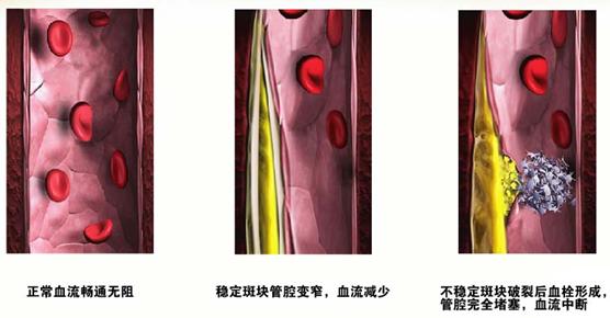 自诊：从四个指标判断高血脂